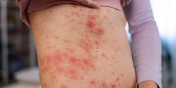 Sinaloa registra su primera defunción por sarampión