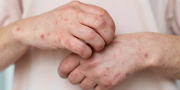 Casos de sarampión en México durante 2026 ya superan el total del año pasado